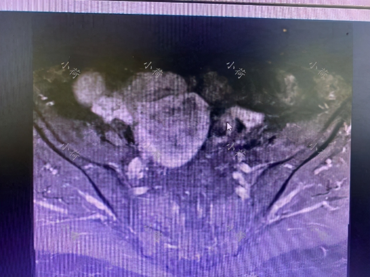 绝经后子宫内膜5毫米一定是癌吗,60岁老人绝经10年发现子宫肌瘤