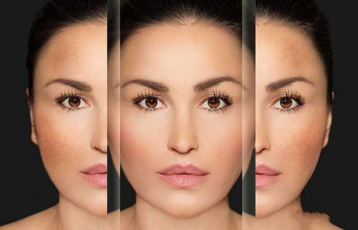 孕期预防长斑护肤,孕期怎么防止褐斑