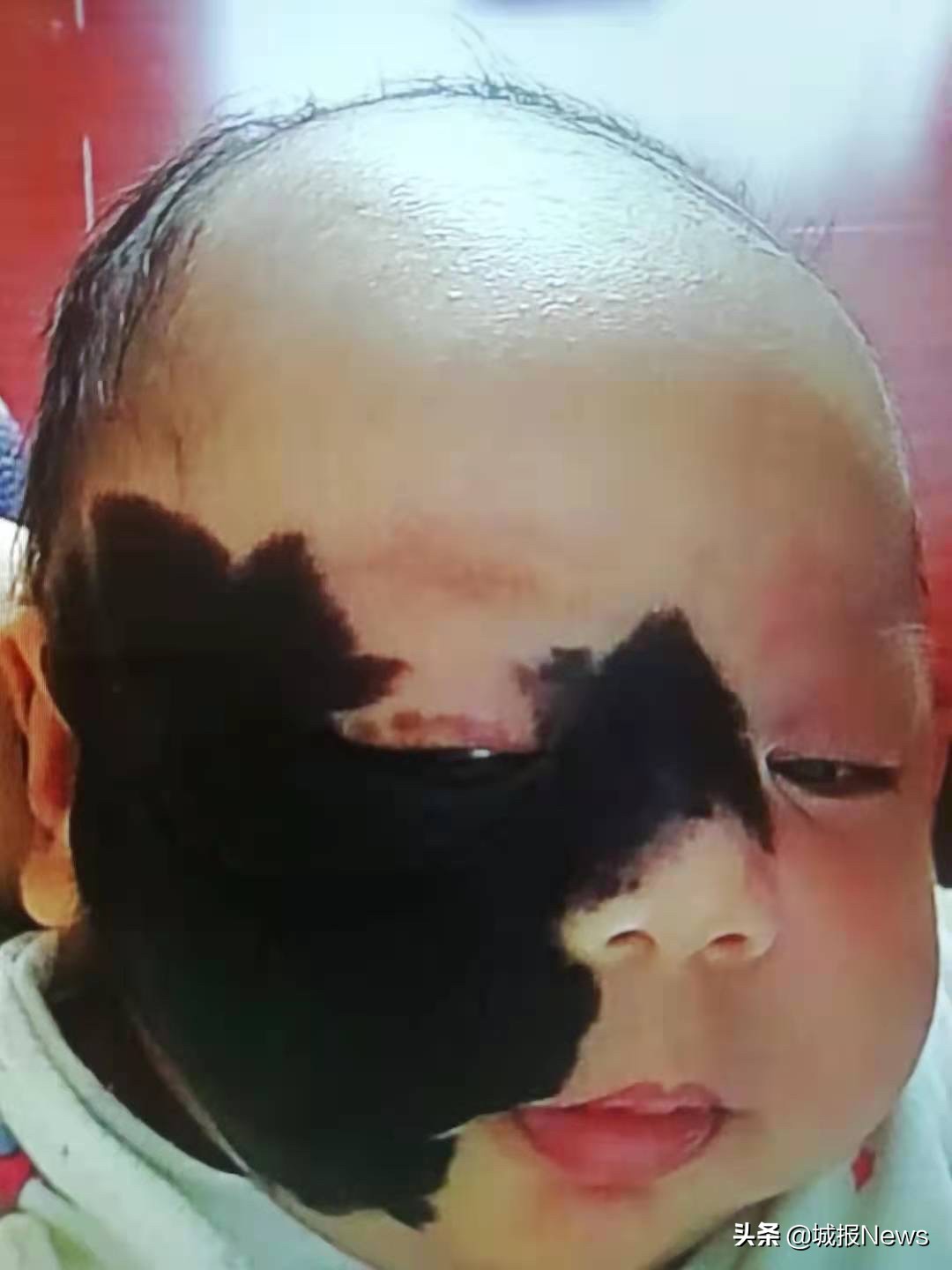 “巨痣”症男童有望告别“熊猫脸”