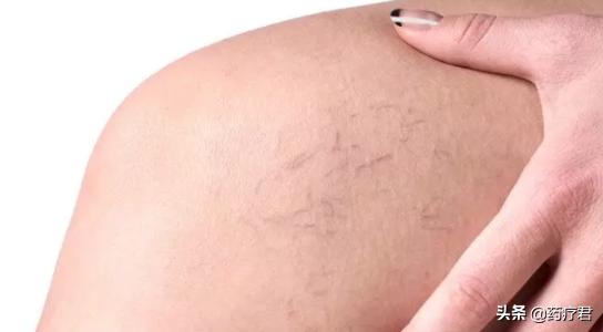 人腿血管都出现血丝是什么原因,站久了腿上有红色血丝是什么原因