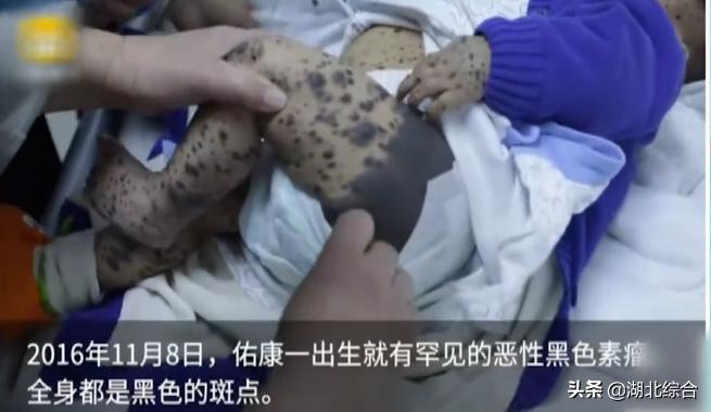 女孩脸上长巨痣,求医治疗却惨变“葫芦娃”?这些痣一定要当心