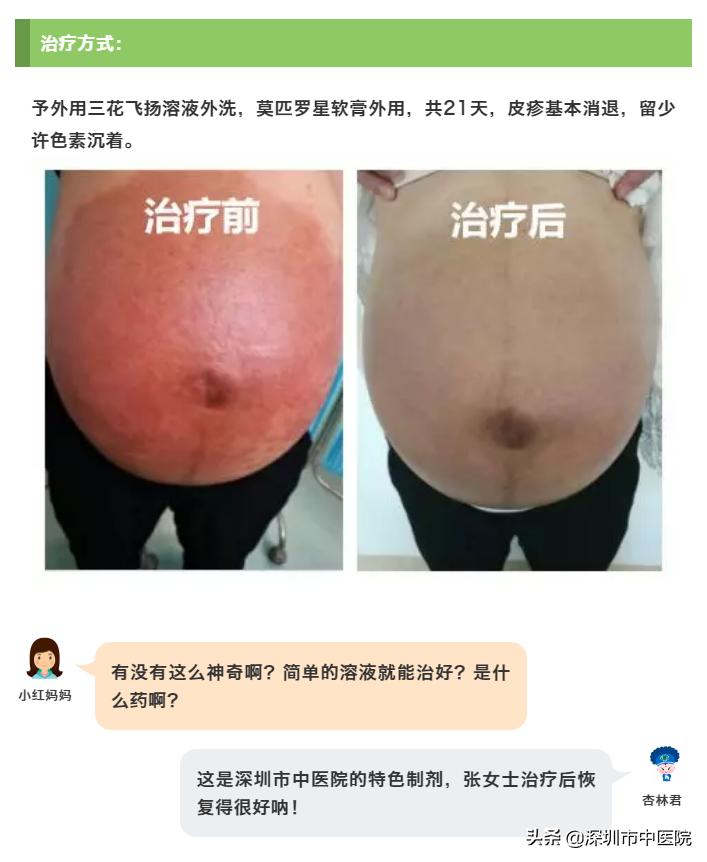孕期湿疹用什么中药,孕期湿疹中药外洗怎么洗