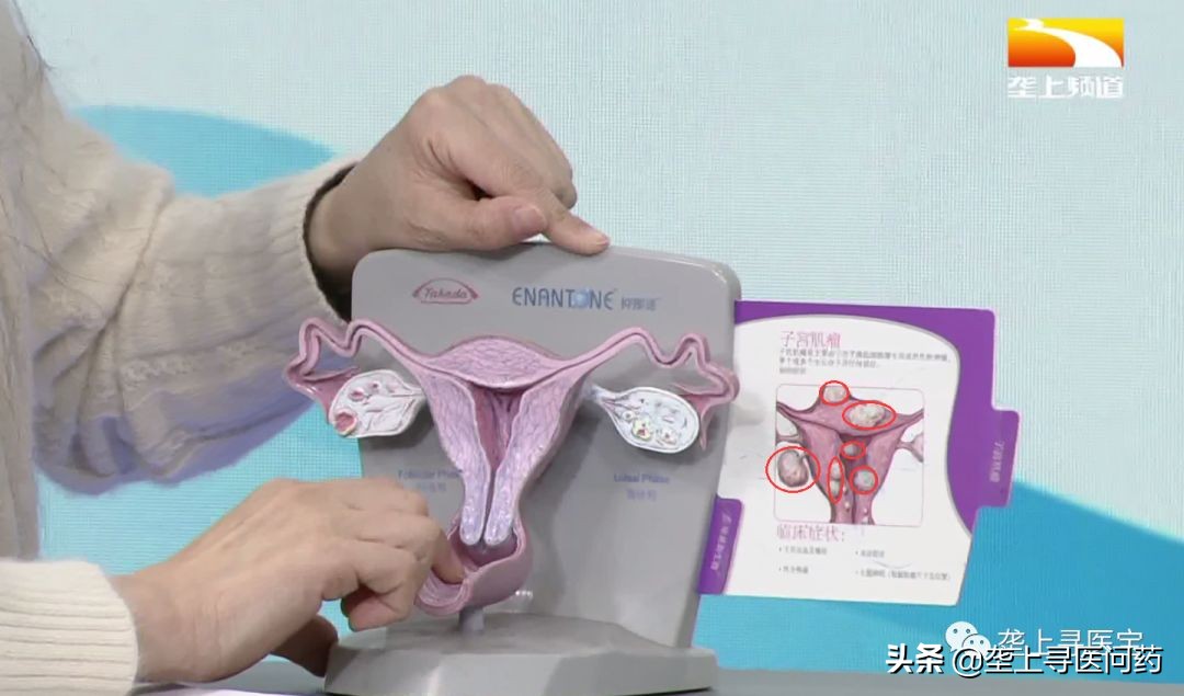 治疗子宫肌瘤宫颈囊肿的食疗偏方,卵巢囊肿宫颈息肉怎么治疗