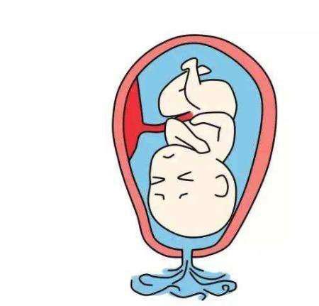 破水了羊水会流光么,破水后看羊水