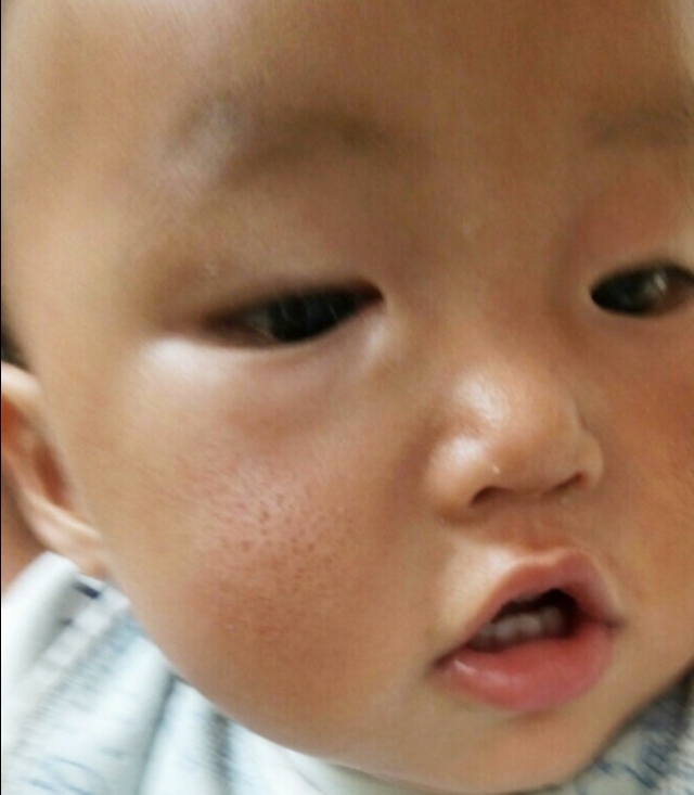 上火眼屎多是什么原因引起的,孩子眼屎多流鼻涕是什么原因