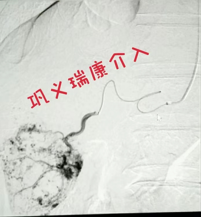 肝血管瘤做微创好还是手术好,巨大肝血管瘤介入手术缺点