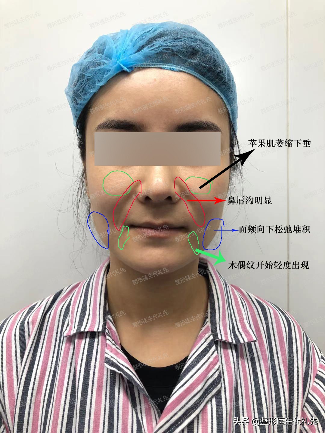 大拉皮和面部微创提升术的区别,小切口面部提升是小拉皮手术吗