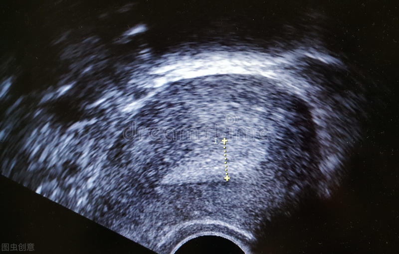 试管婴儿移植冻胚前有什么流程,自然周期冻胚移植为什么要打hcg