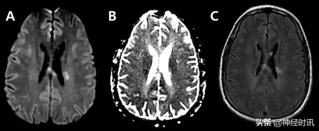 脑卒中的快速识别ppt,脑卒中神经影像学实例解析