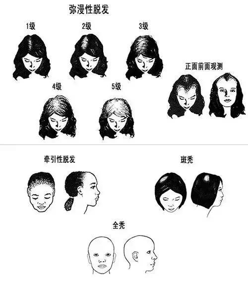 女人脱发,女性其实比男性秃
