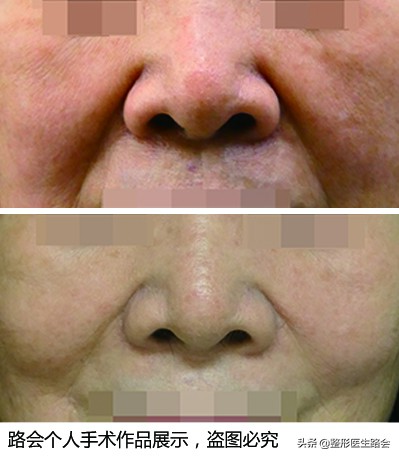 拉皮去法令纹怎么去除最安全永久,做拉皮能去除法令纹能坚持多久