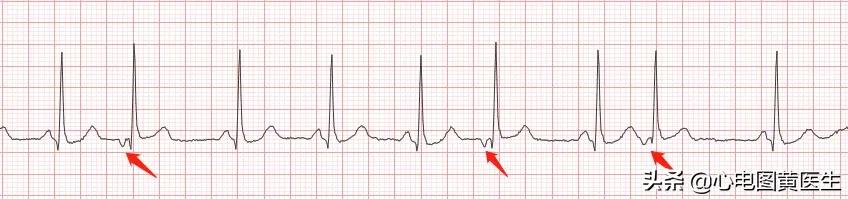 频发室性早搏部分为室性融合波,室性早搏与差异性传导鉴别