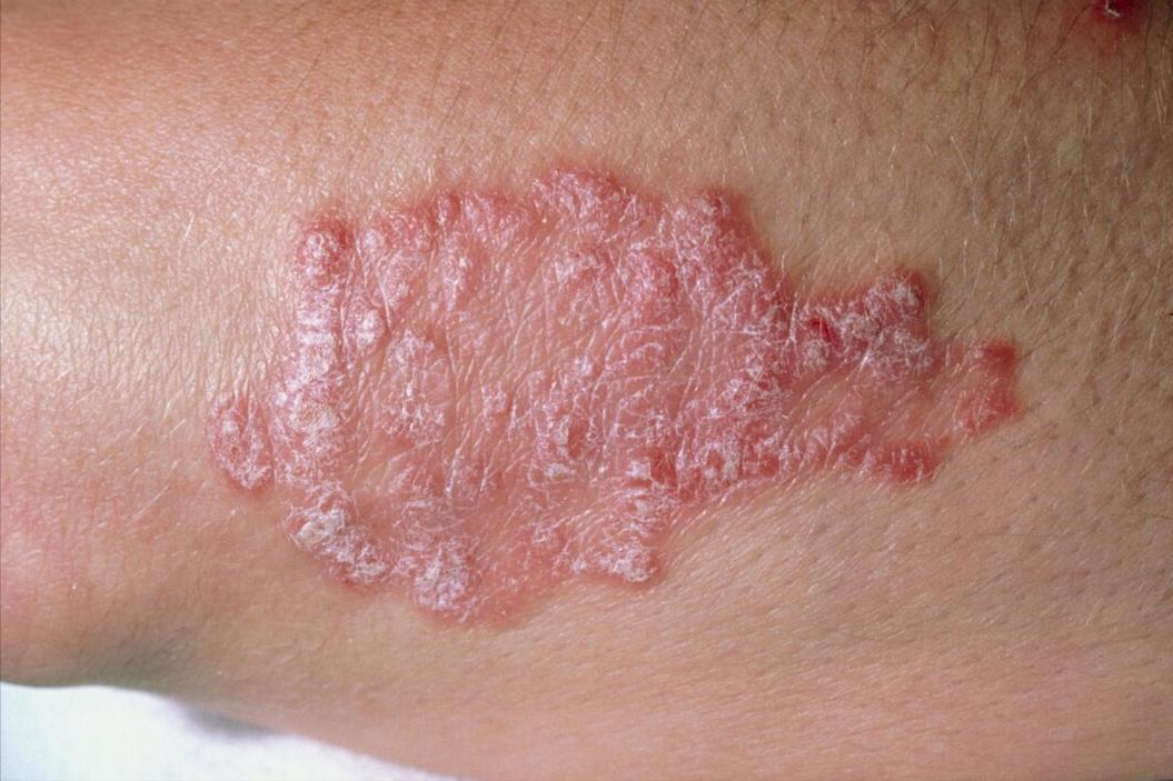 激素治疗牛皮癣有什么危害,治疗牛皮癣的针剂有哪些危害