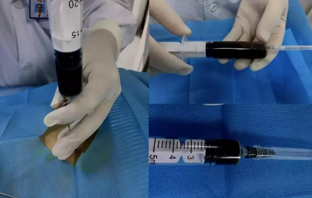 病例分享：无计可施时「黑色的」胸腔积液使治疗找到了方向