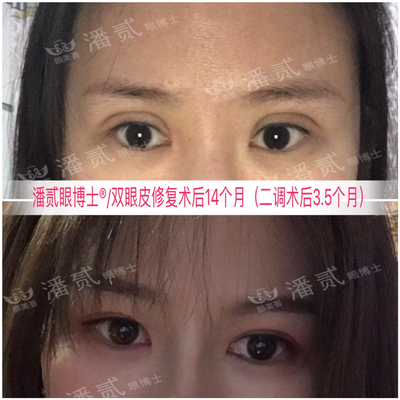 广州双眼皮凹陷修复视频,小切口双眼皮肉条修复