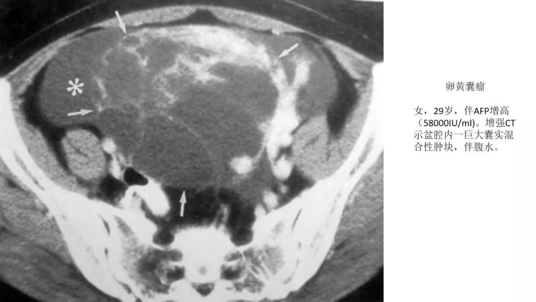 卵巢原发肿瘤的分析思路