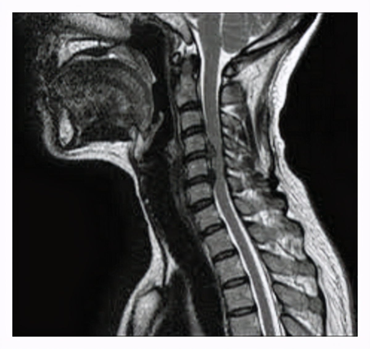 颈椎病摔跤如何治疗,颈椎病引发摔跤怎么办视频