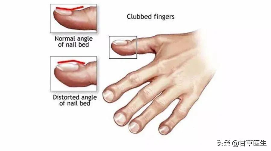 指甲出现这几种变化可能是肿瘤,心血管疾病指甲有变化吗