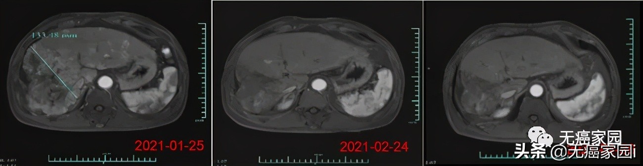 四川华西car-t疗法肝癌成功案例,全球首个car-t治疗晚期肝癌成果