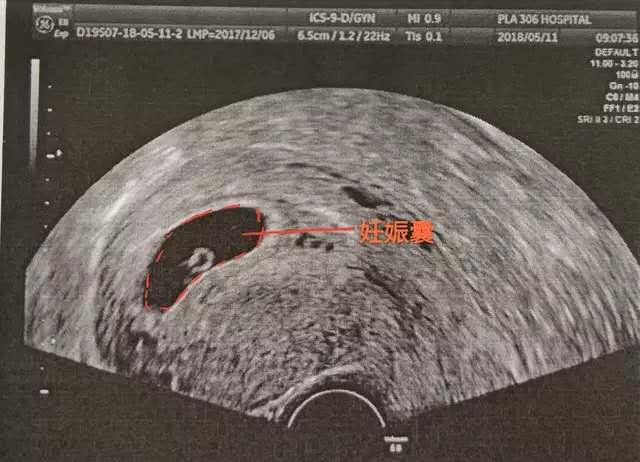 怀孕多久做B超比较好,怀孕多久做b超可以查到孕囊