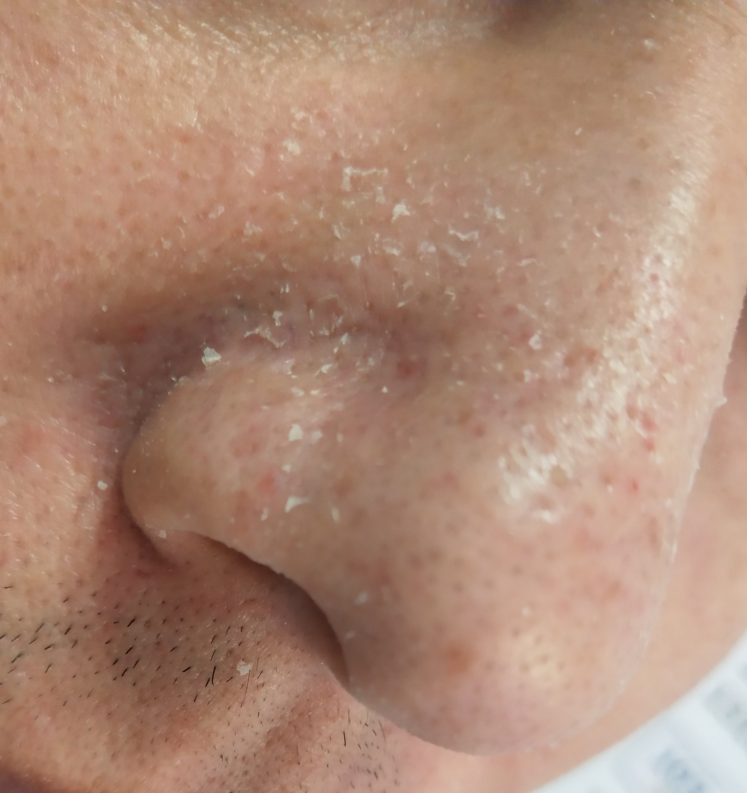 鱼刺卡喉的真实经历,鱼刺卡喉半年寻医无果