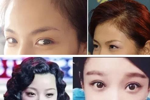欧式双眼皮适用什么眼型,双眼皮平行型和欧式型有什么区别