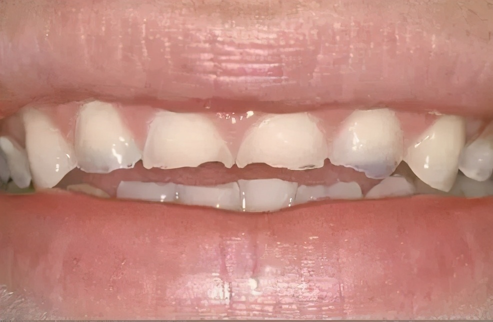 牙齿掉渣怎么处理,牙齿内部掉渣怎么治疗