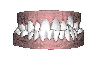 牙齿矫正全过程都在这里了,牙齿矫正一定要知道的事儿