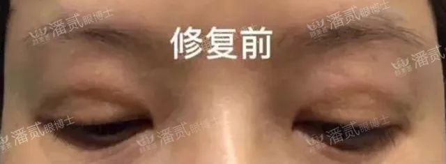 全切双眼皮提肌失败还能修复吗,什么是失败的双眼皮