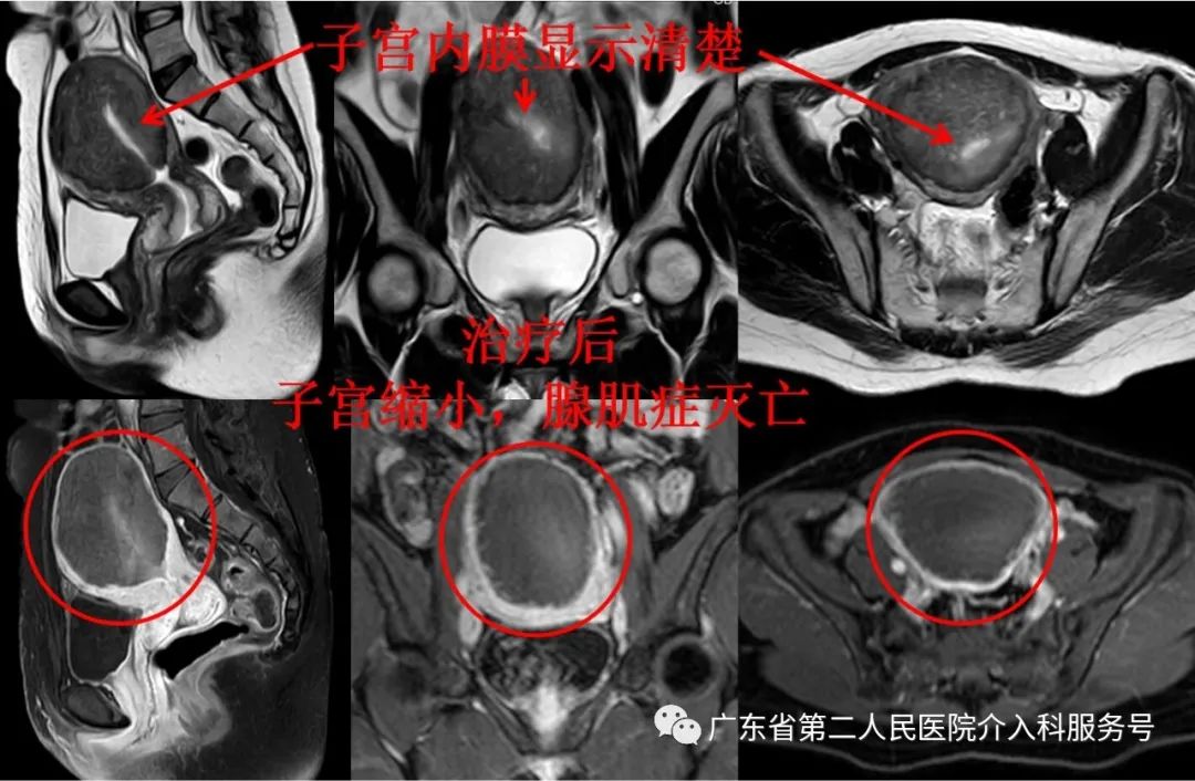 49岁腺肌症痛经月经量大怎样治疗,子宫腺肌症子宫增大痛经不明显