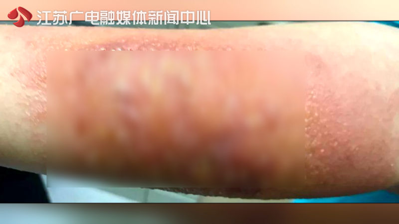 烫伤用青草膏后红肿疼痛怎么办,烫伤起水泡可以抹青草膏吗