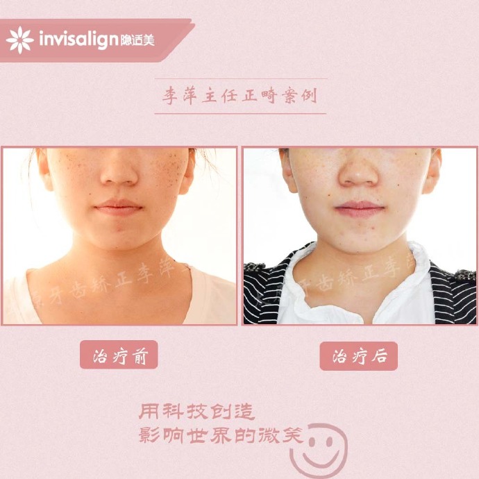 太原牙齿矫正拔牙拔六颗有危害吗,太原牙齿开合矫正