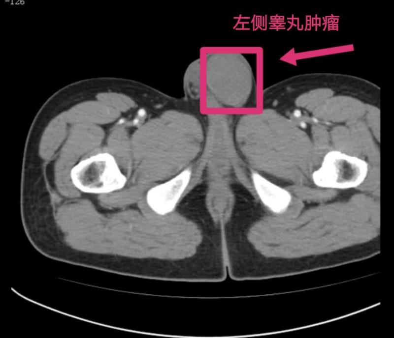 男子睾丸症状,男子睾丸肿大是什么原因