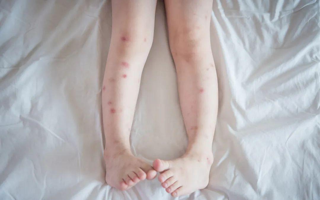 夏天蚊虫叮咬用什么方法迅速止痒,蚊虫叮咬缓解痒的小妙招