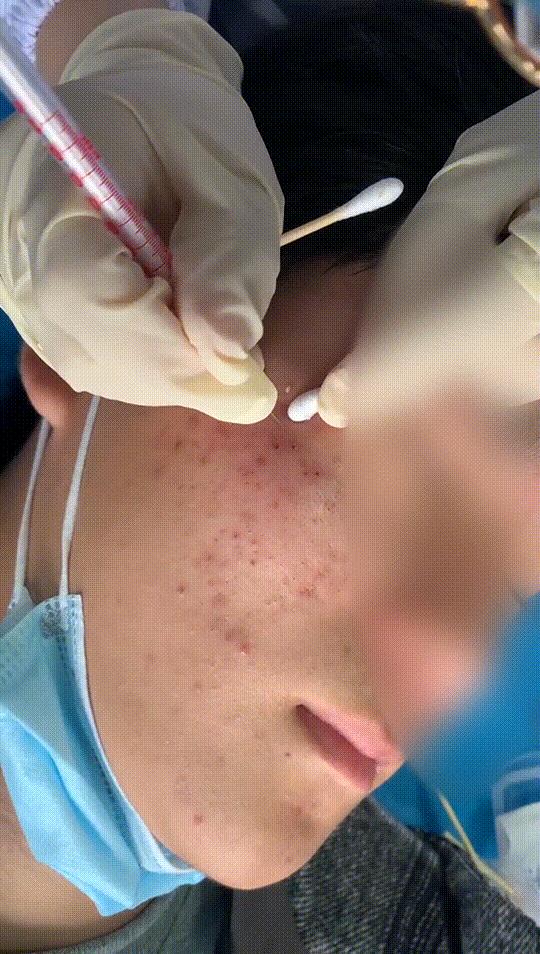 挤痘痘要怎么玩,挤痘痘有什么神操作