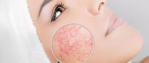 去除高原红红血丝最快的方法,怎么区分高原红和红血丝