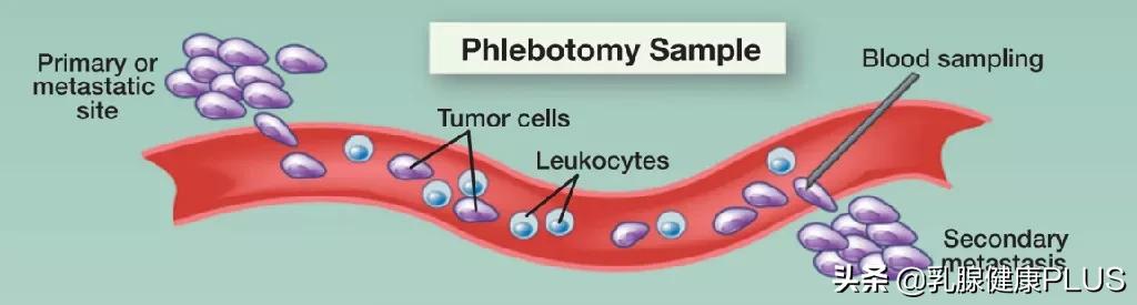 ctc检测肿瘤的机构,ctc检测肿瘤细胞5个