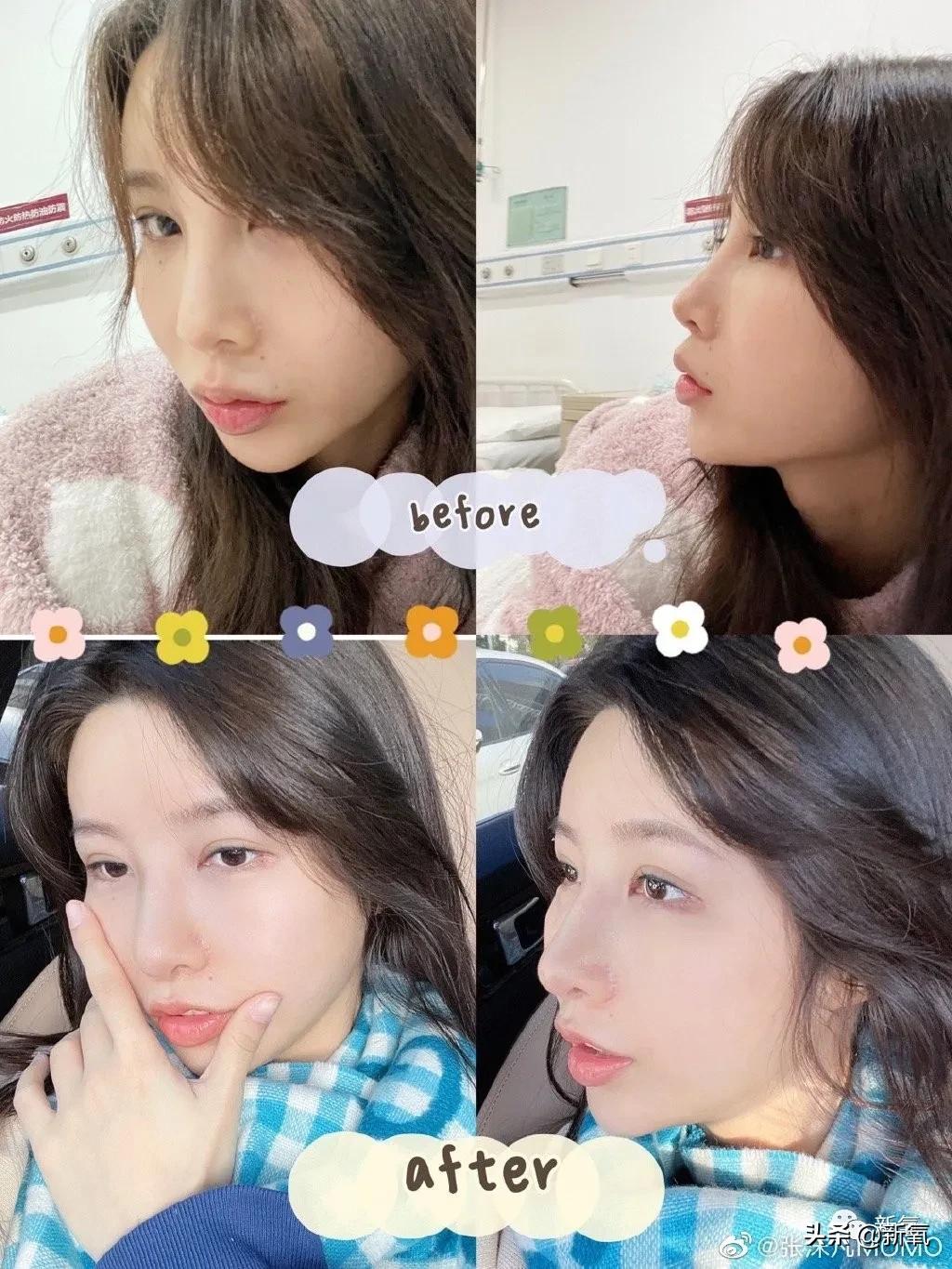 网红整鼻子整出坑,千万网红被坑