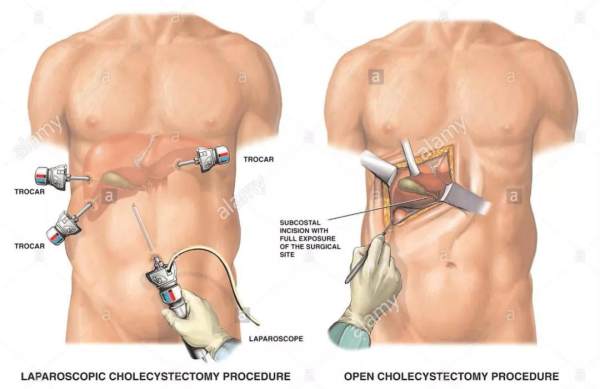 胆囊息肉伴有胆囊结石怎么办,胆囊息肉胆囊结石胆囊炎吃什么药
