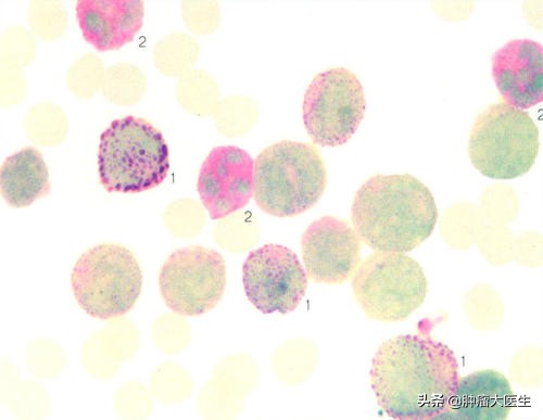 不查不知道一查吓一跳的肿瘤标志物到底预示什么病？