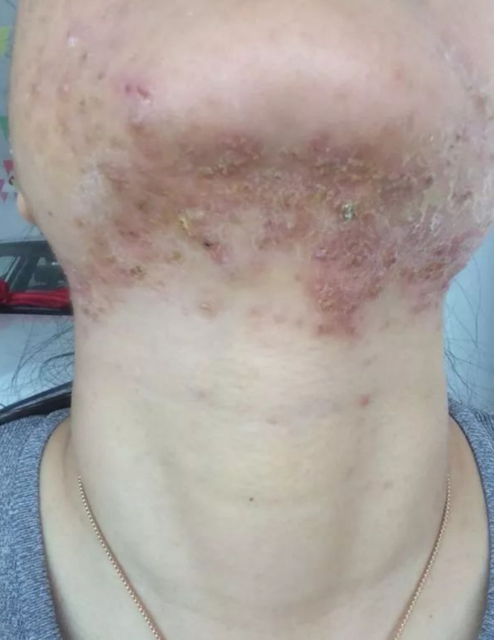 科普微针祛痘,消炎修复和祛痘