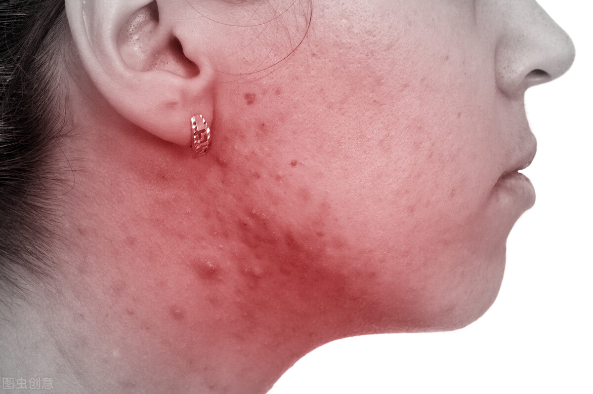 玫瑰痤疮反复发作怎么治疗,痤疮常见皮损不包括
