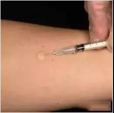 过敏是免疫系统弱还是过强,皮肤容易过敏是免疫系统问题吗