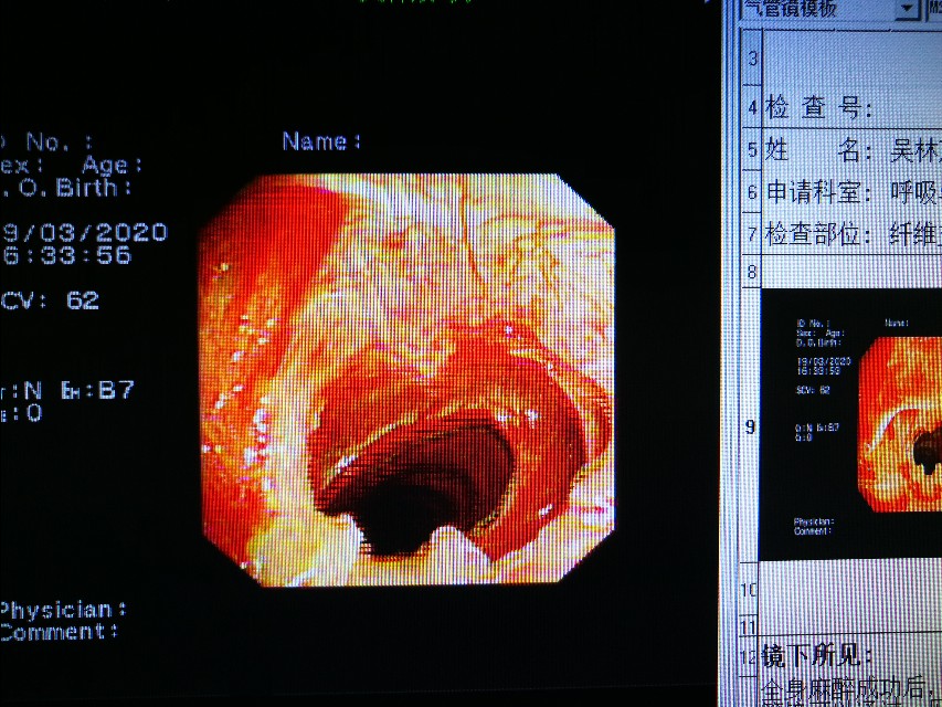 经支气管镜球囊扩张治疗气道狭窄,支气管镜球囊扩张操作视频