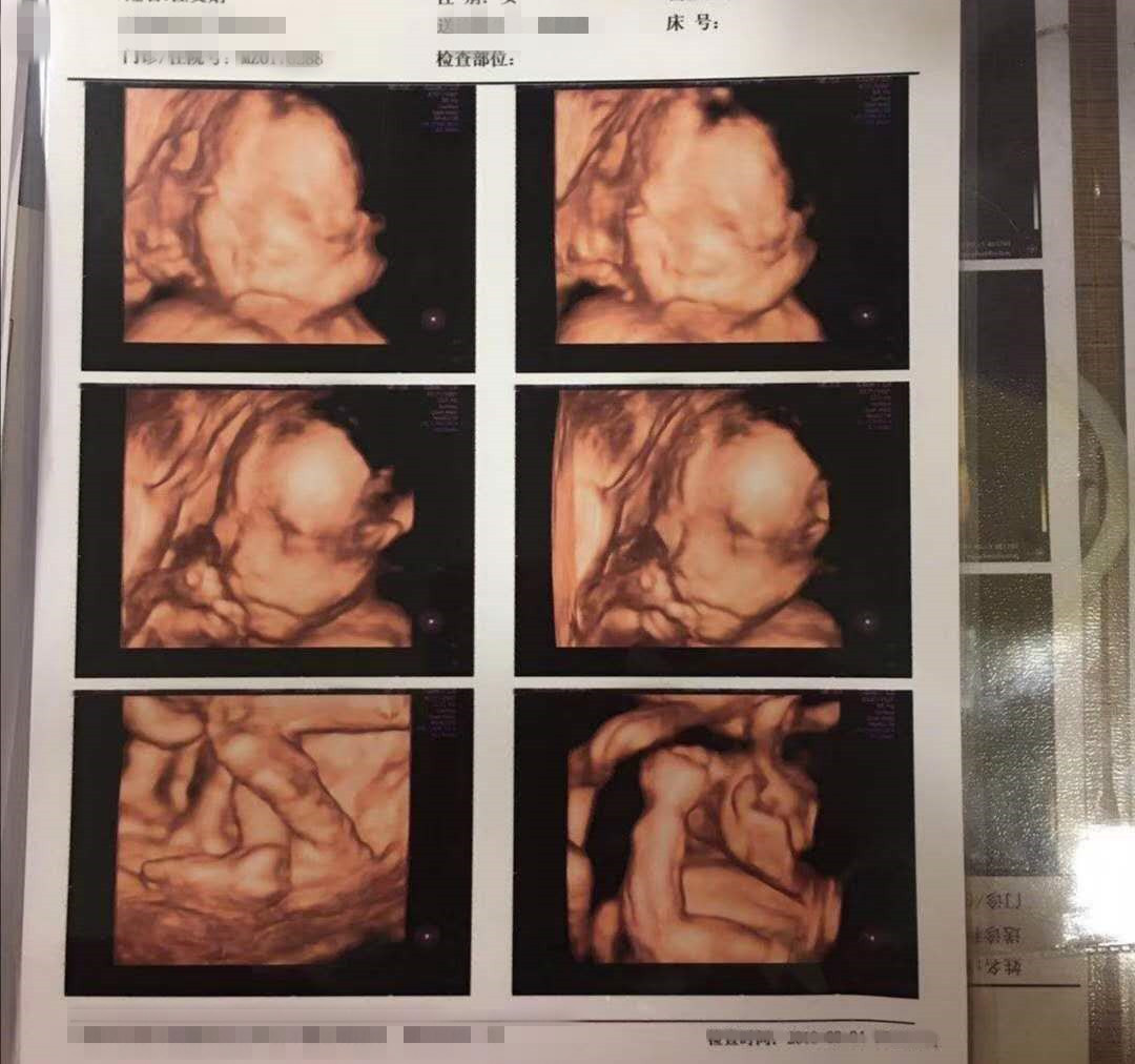 双胞胎！四维顺利通过啦！七年的等待终于盼来好结果！