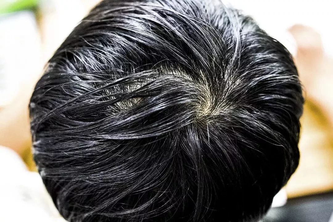 “十男八秃”的日本男人疯抢这瓶小黑钻!让头发不再掉了