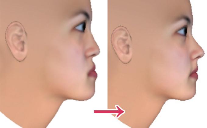 骨性龅牙怎么弄,如何判断骨性龅牙的轻重程度