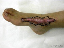 烫伤疤痕增生很硬很痒用什么药,烫伤疤痕增生怎么治疗最好