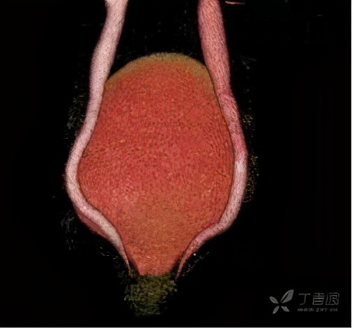 尿路梗阻导致肾积水不及时治疗,双肾积水是尿路梗阻吗