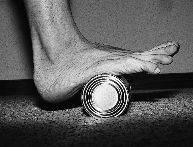 足底感觉有刺痛感是足底筋膜炎吗,路走多了脚底板疼可以用冰敷嘛